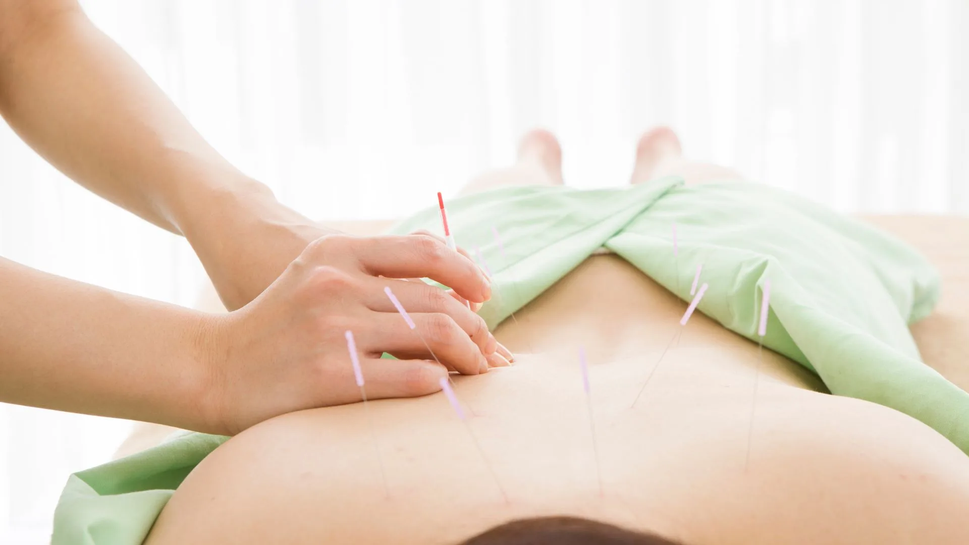 A practitioner performs acupuncture on a patient's back to alleviate pain and promote healing.