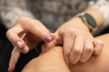 Acupuncture