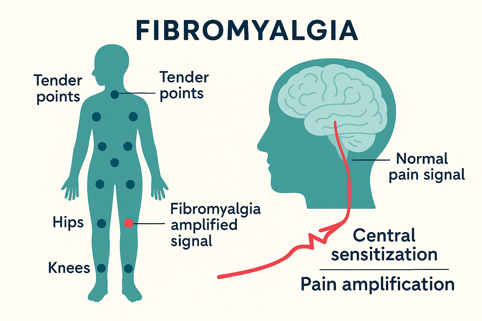 Fibromyalgia anatomy diagram